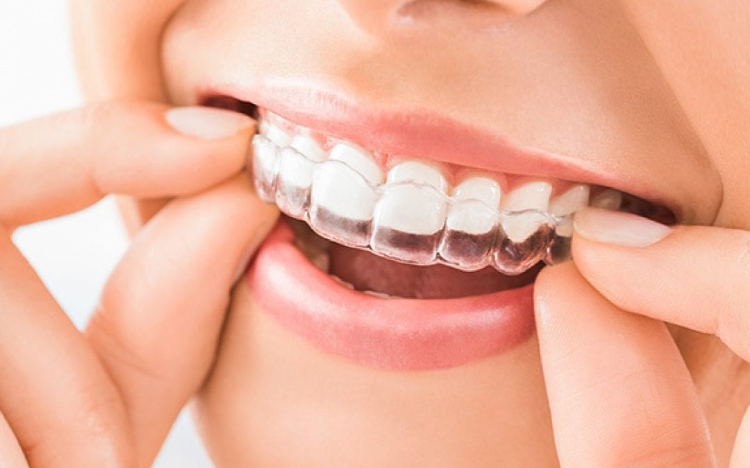 Should I wear a nightguard