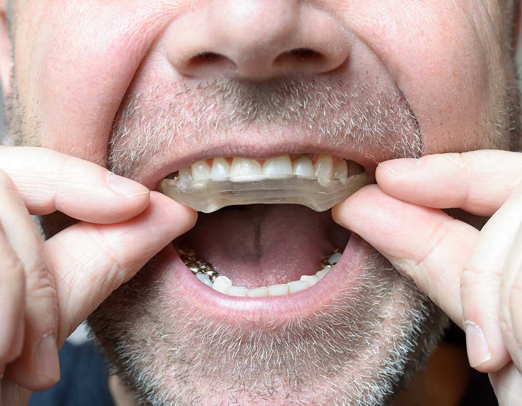 Should I wear a nightguard, nighttime dental appliance, dental night protector, teeth grinding guard, oral splint, occlusal guard, dental mouthguard, bruxism device, nighttime bite guard, dental occlusal appliance, nocturnal teeth protector, sleep teeth guard, night teeth protector, grinding teeth shield, dental bruxism guard, nocturnal mouthpiece, night grinding retainer, sleep dental guard, oral sleep protector, bruxism night shield, teeth clenching retainer, dental sleep appliance, night bruxism retainer, sleep bruxism guard, night mouth guard